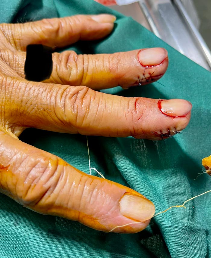 ฝังแม่เหล็กที่นิ้วมือ