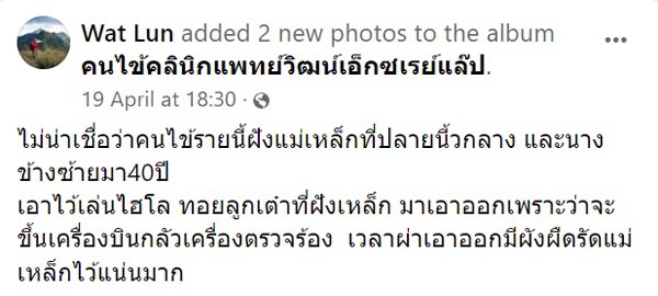 ฝังแม่เหล็กที่นิ้วมือ