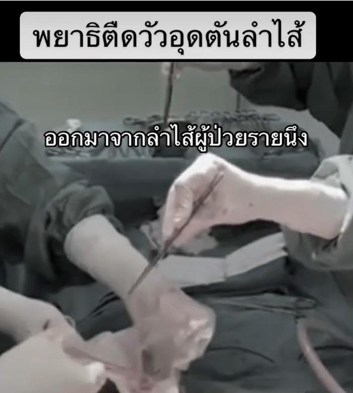 พยาธิตัวตืด