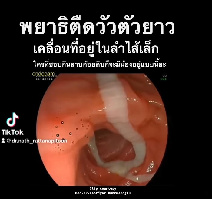 พยาธิตัวตืด