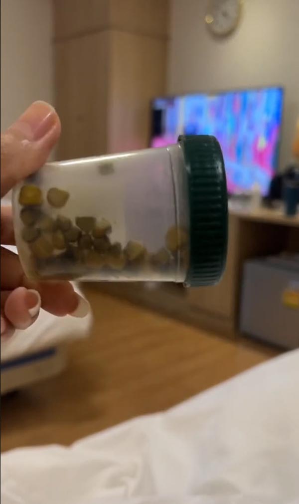 กินชานมไข่มุกเยอะจนเป็นนิ่ว