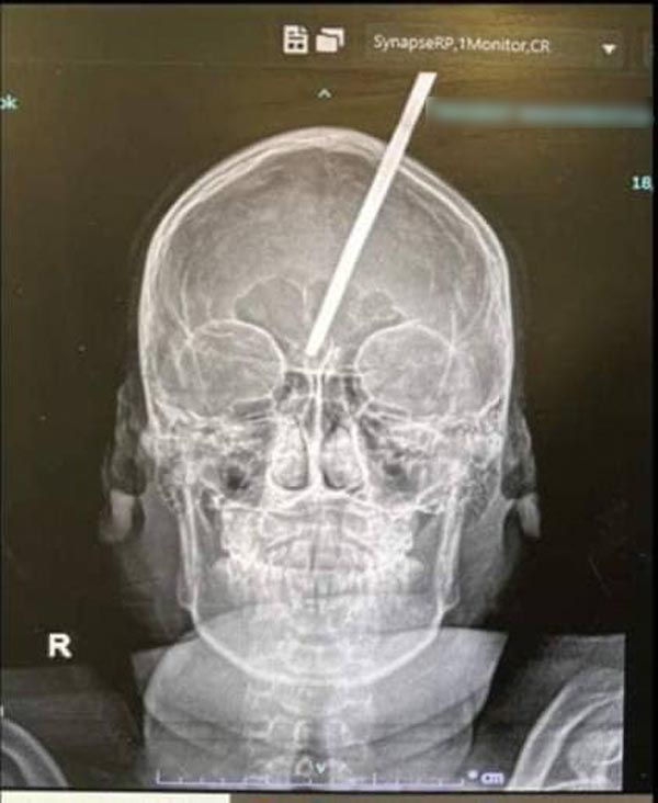 ลูกดอกปักกะโหลก