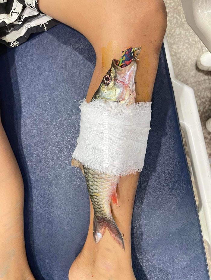 เบ็ดปักขาจนปลาติดขา