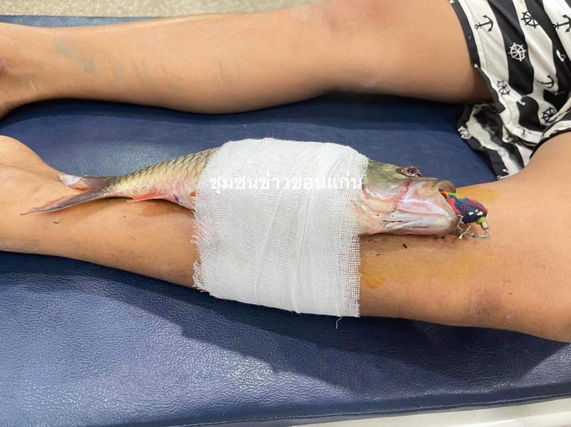 เบ็ดปักขาจนปลาติดขา