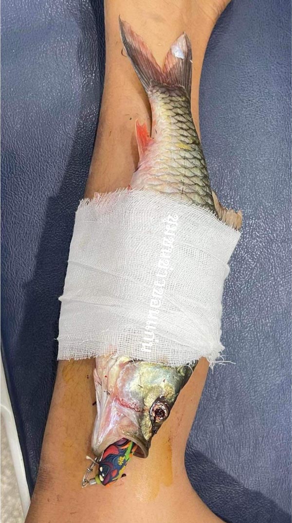 เบ็ดปักขาจนปลาติดขา