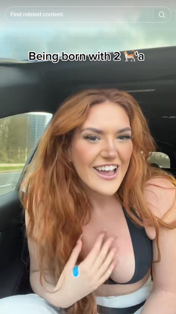 สาวมีมดลูกแฝดคบซ้อน