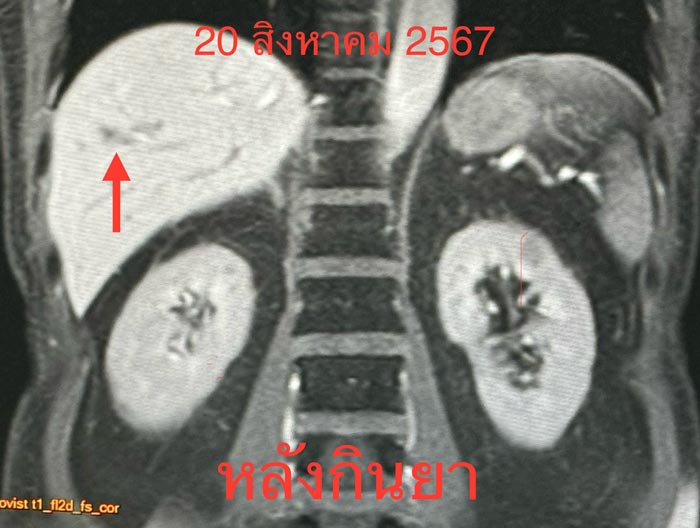 ฝีในตับ