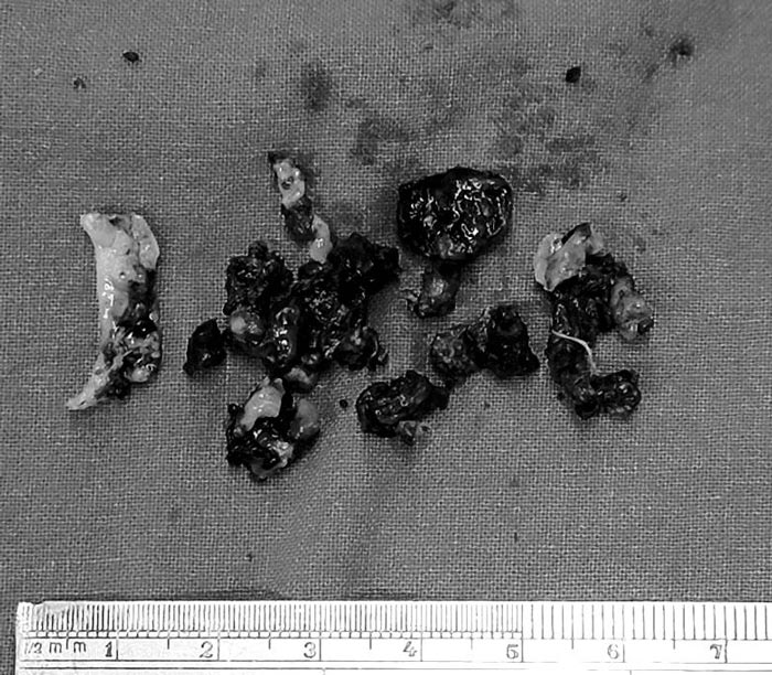 ก้อนเชื้อราในโพรงจมูก