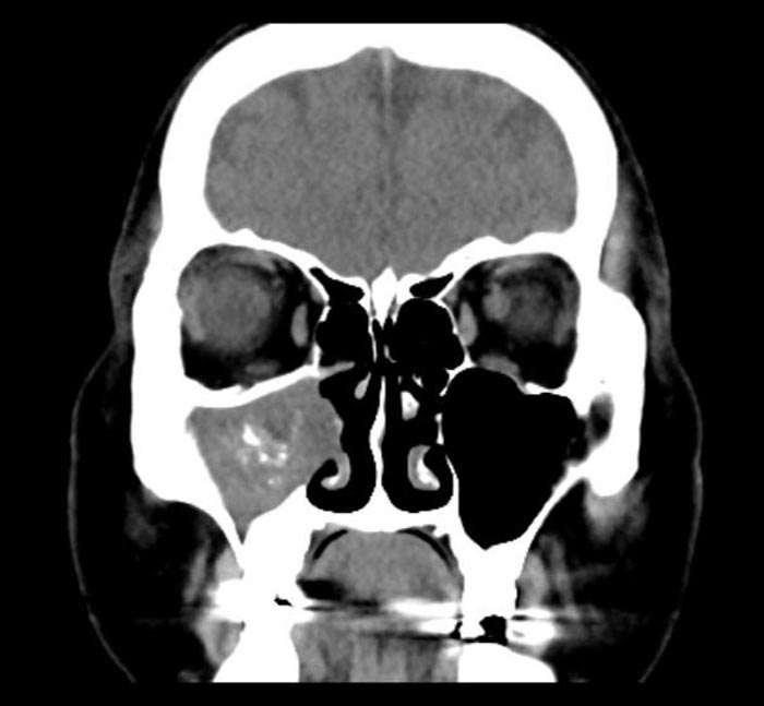 ไซนัสอักเสบจากเชื้อรา