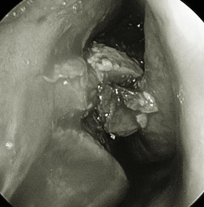 ไซนัสอักเสบจากเชื้อราแบบไม่รุกราน