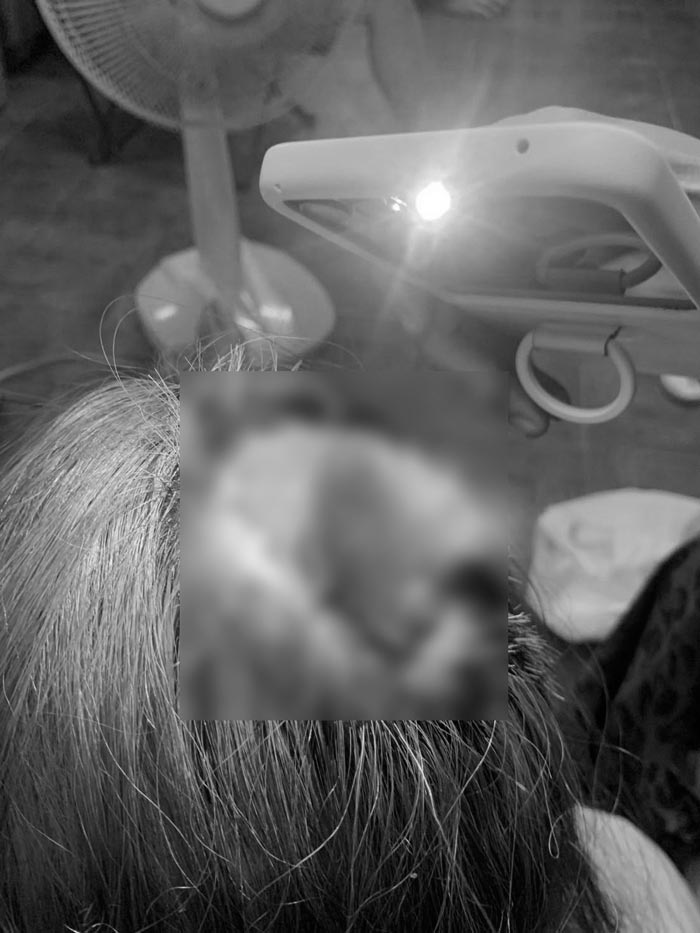 ทำสีผมหนังศีรษะเป็นแผล