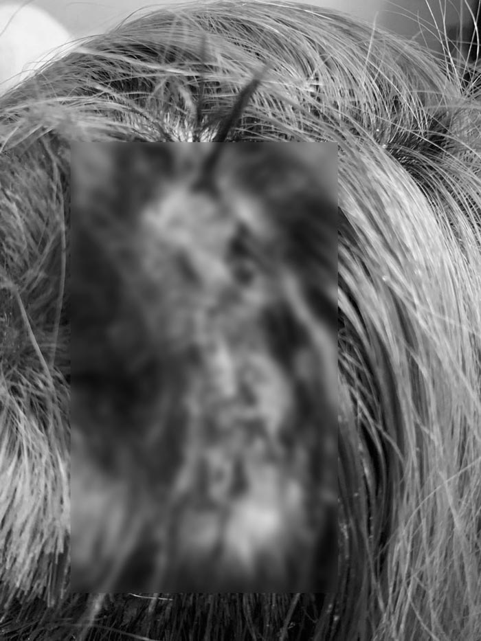 ทำสีผมแผลติดเชื้อ