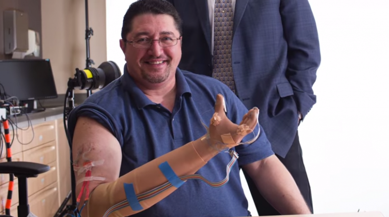 มือเทียมไบโอนิก