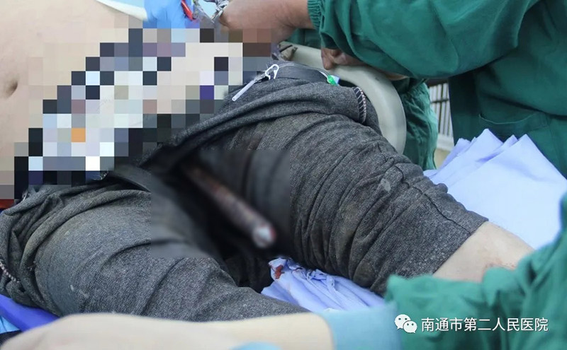 เหล็กเสียบขาหนีบคนงานก่อสร้าง