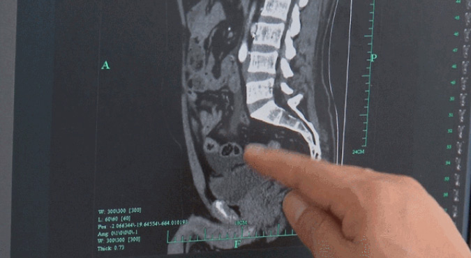 กลั้นฉี่นาน กระเพาะปัสสาวะฉีก 