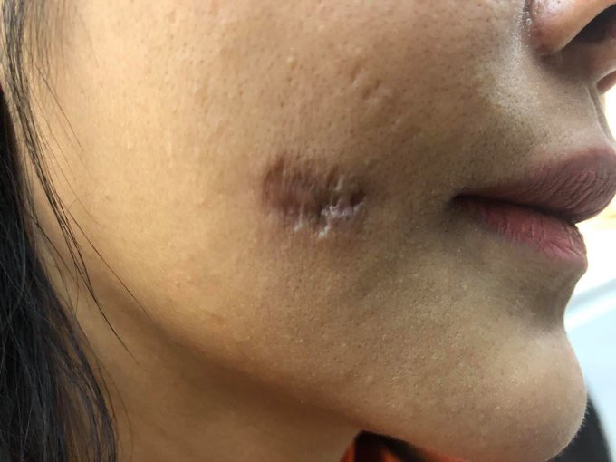 Hifu ยกกระชับหน้า