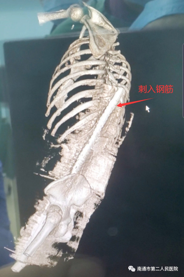 เหล็กเสียบขาหนีบคนงานก่อสร้าง