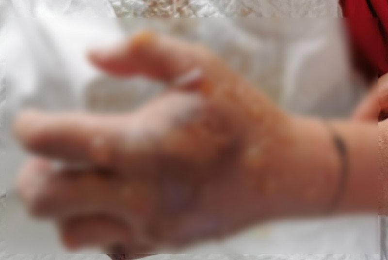 ก้างปลาทิ่มจนมือเน่าต้องตัดทิ้ง