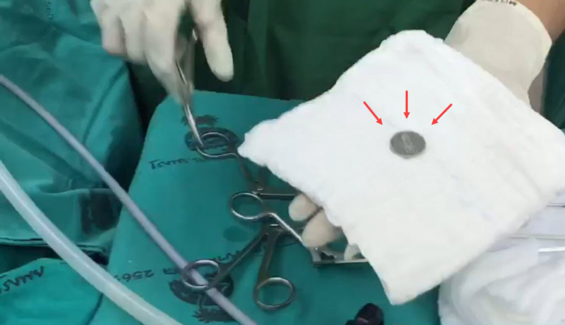 เหรียญติดคอเด็ก