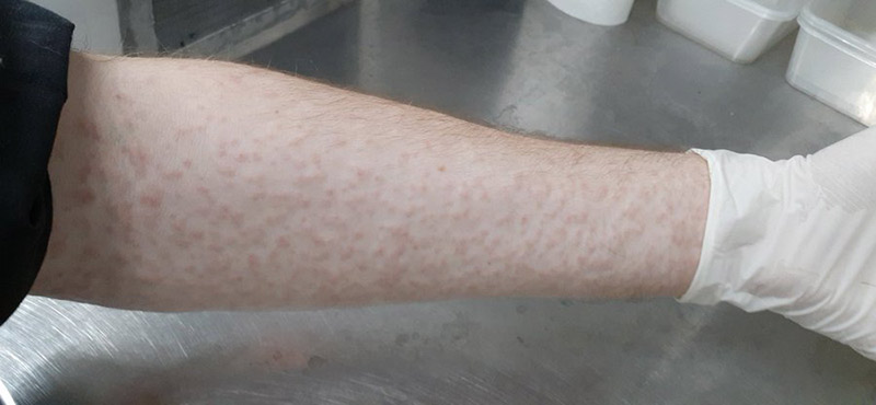 วิจัยให้ยุงกัดแขน