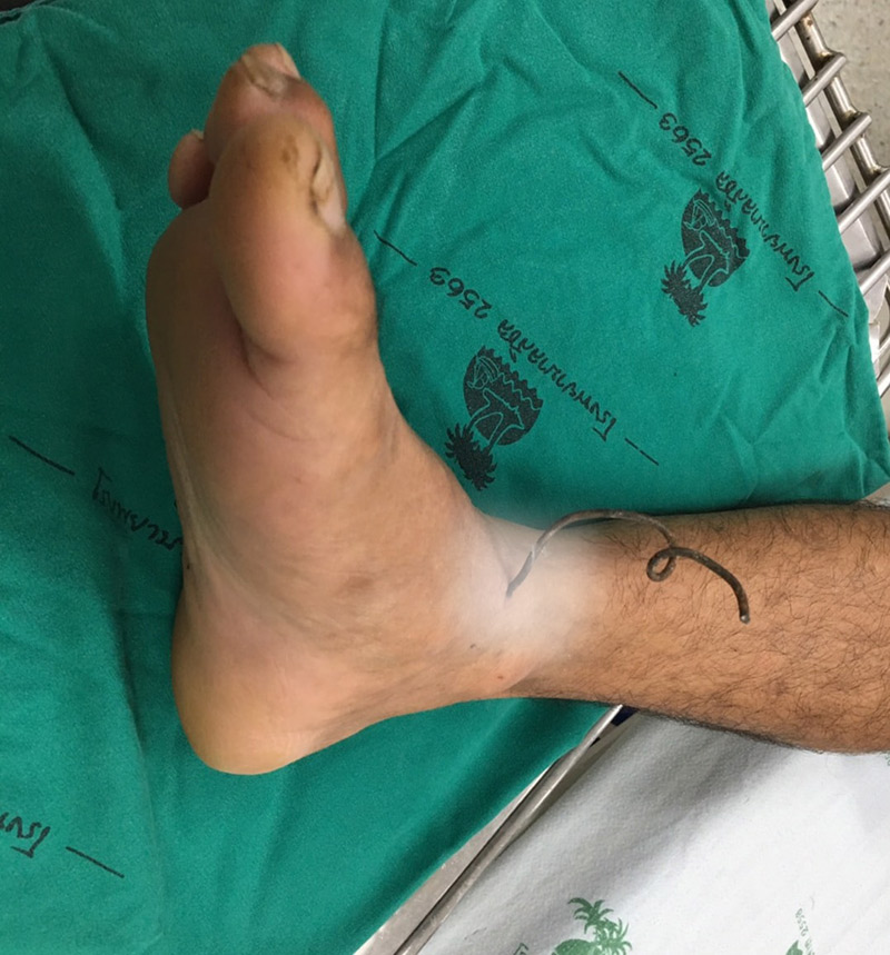 เหล็กเสียบขาคนตัดหญ้า