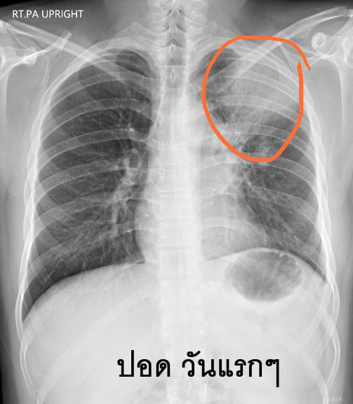 มะเร็งต่อมน้ำเหลือง