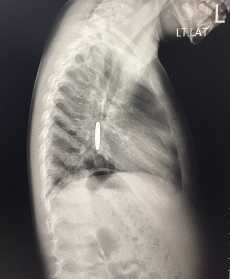 เหรียญติดคอเด็ก