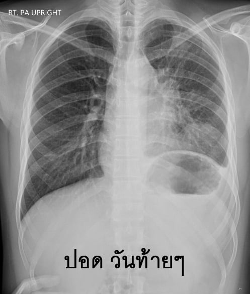 มะเร็งต่อมน้ำเหลือง