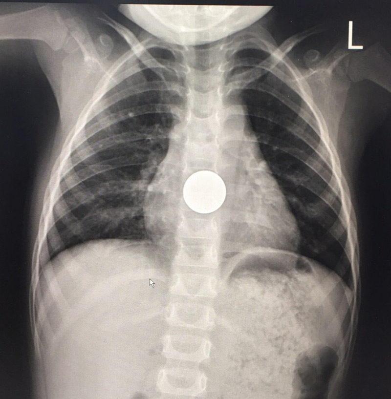 เหรียญติดคอเด็ก