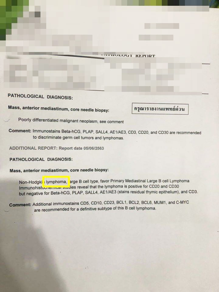 มะเร็งต่อมน้ำเหลือง