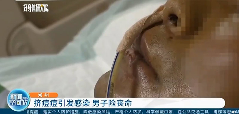 บีบสิว ป่วยหนักปางตาย