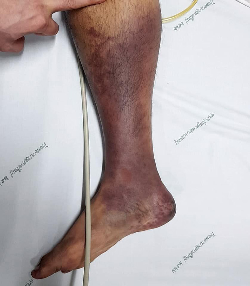 ถูกตัดขา