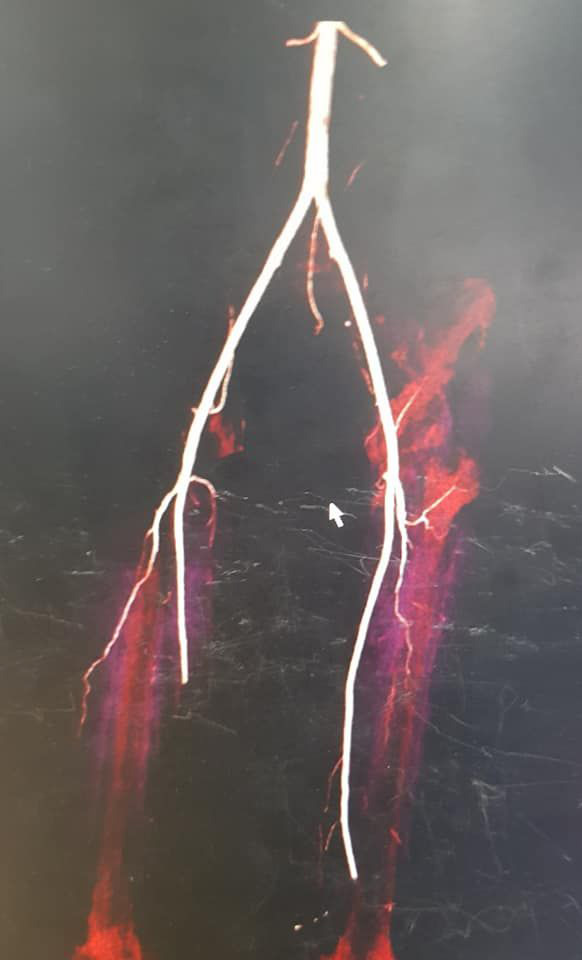 ถูกตัดขา