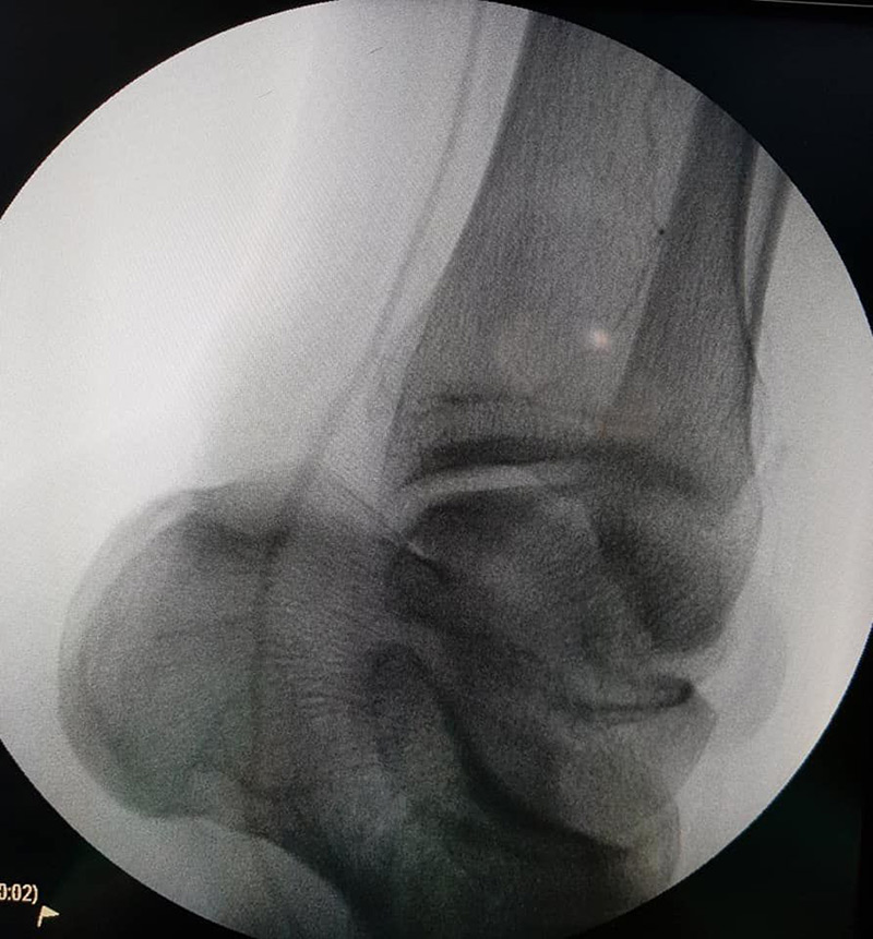 ถูกตัดขา