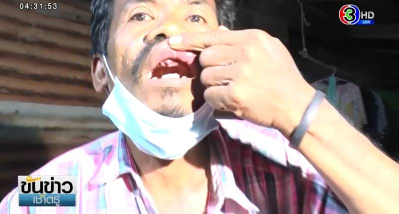 ผู้ใหญ่บ้านต่อยลูกบ้านฟันร่วง