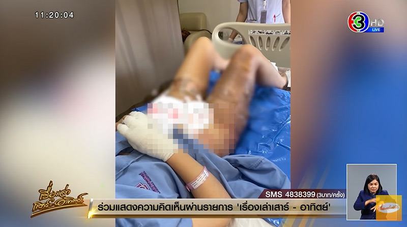 หม้อจิ้มจุ่มตกใส่ตัวแผลเหวะหวะ