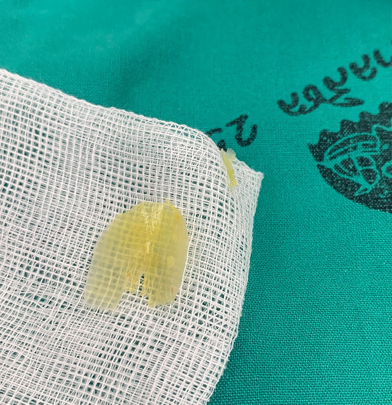 เปลือกกุ้งแทงหลอดอาหาร