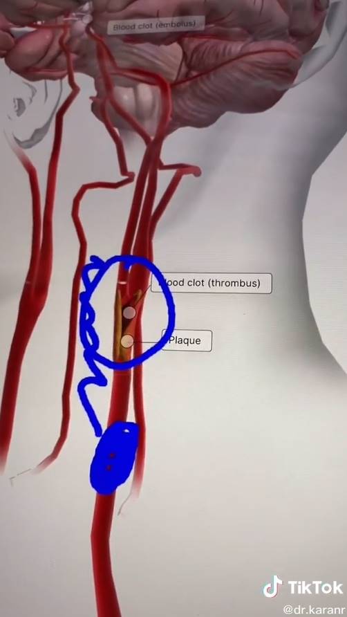สาวโดนดูดต้นคอ กลายเป็นอัมพาต 