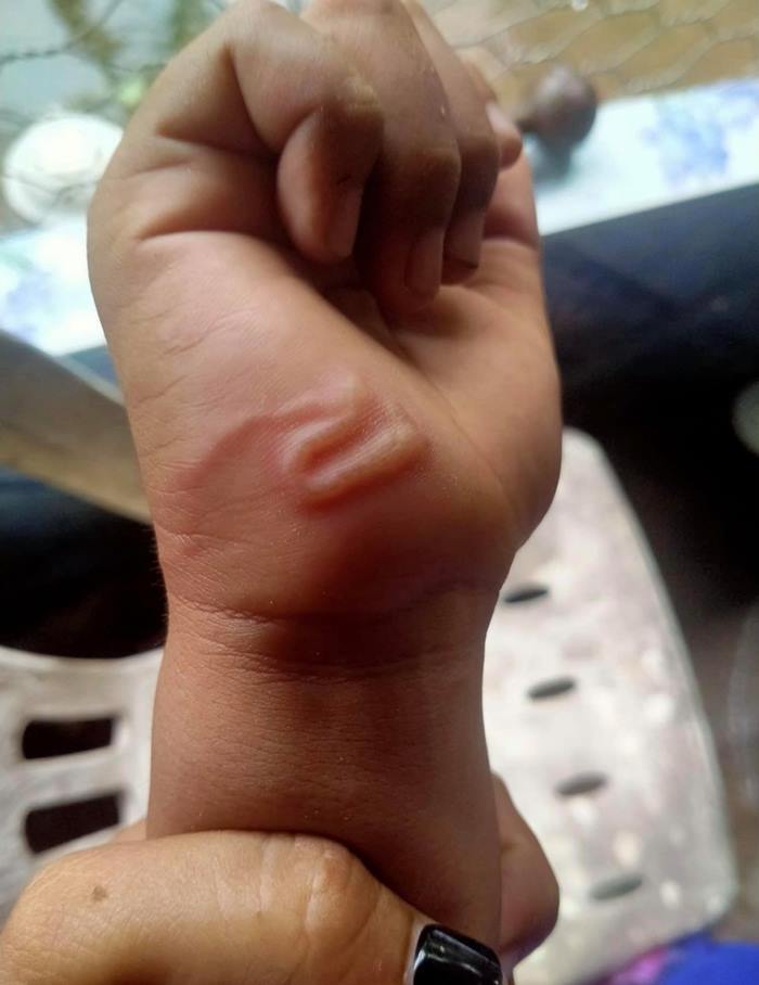 พยาธิไชมือ