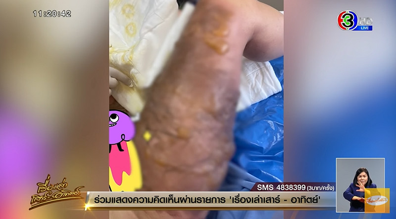 หม้อจิ้มจุ่มตกใส่ตัวแผลเหวะหวะ