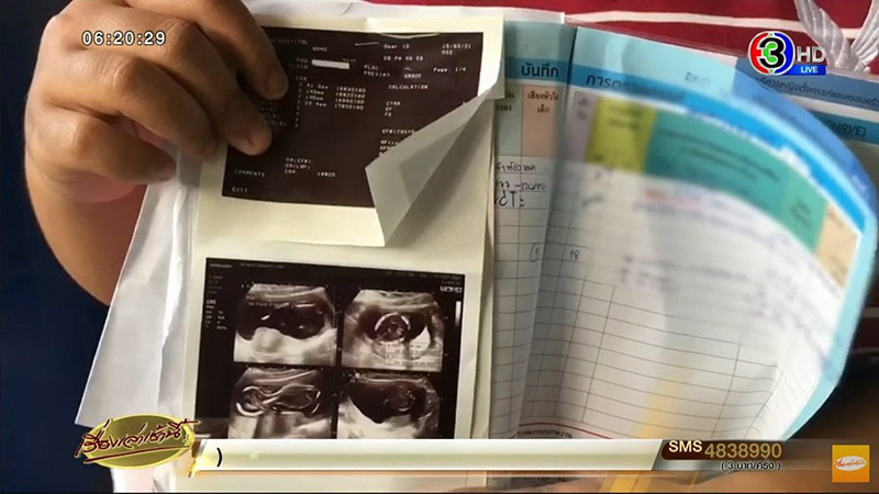 ครรภ์เป็นพิษ ขูดมดลูกแต่เด็กยังอยู่