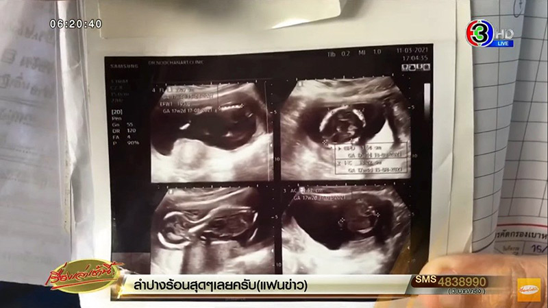 ครรภ์เป็นพิษ ขูดมดลูกแต่เด็กยังอยู่