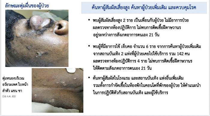 ฝีดาษลิง 