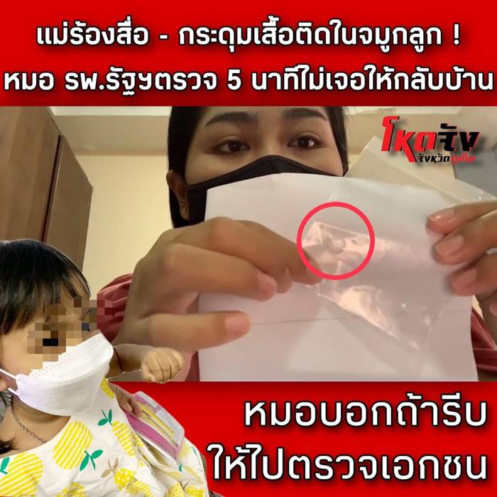 แม่โวยหมอโรงพยาบาลรัฐ กระดุมติดจมูกลูก