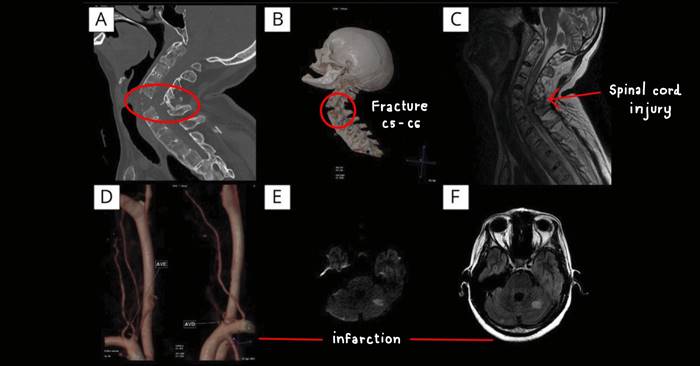 เตือนภัยสุขภาพ จัดกระดูกคออัมพาตทั้งตัว 