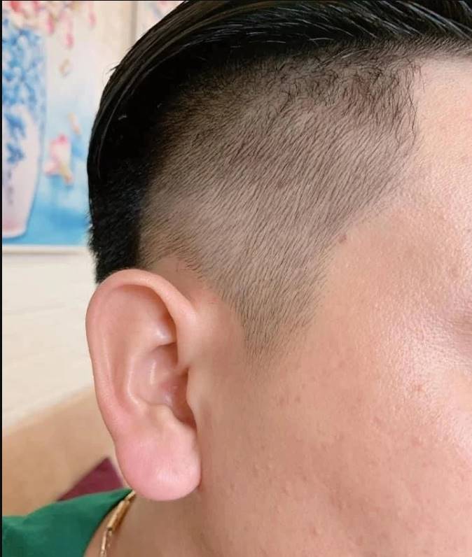 ฉีดฟิลเลอร์ติ่งหู สไตล์พระสังกัจจายน์