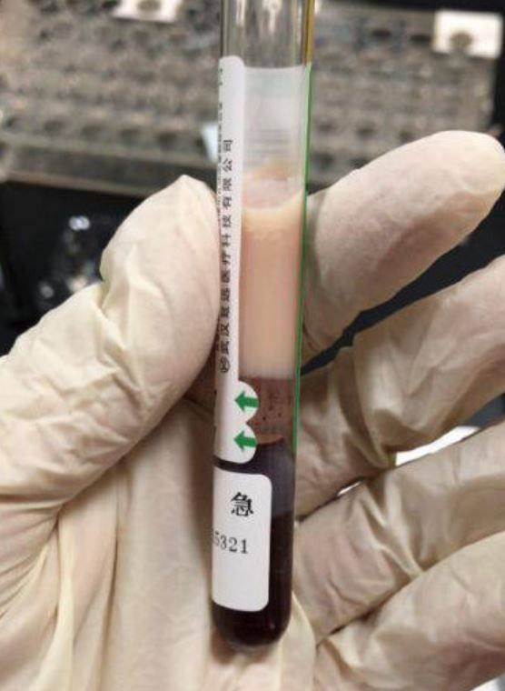 หนุ่มชอบกินชานมจนเลือดกลายเป็นนม