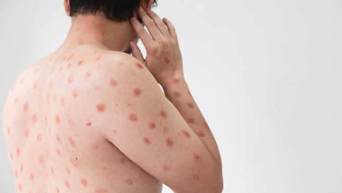 ฝีดาษลิง