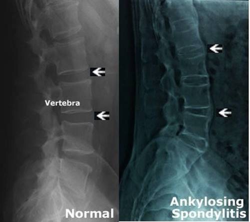 เตือนภัยสุขภาพ จัดกระดูกคออัมพาตทั้งตัว 