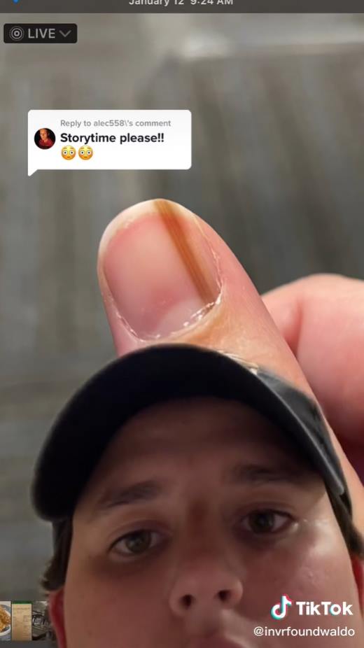 มะเร็งใต้เล็บ